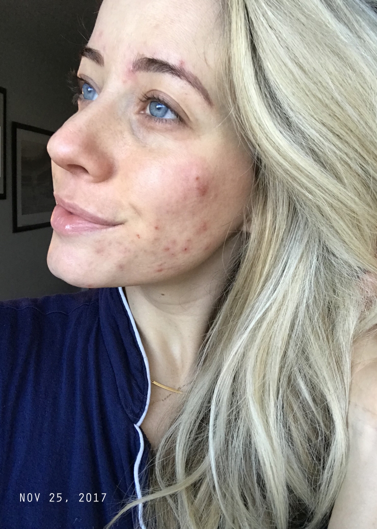 How To Clear Up Hormonal Acne + My Journey - Twist Me Pretty