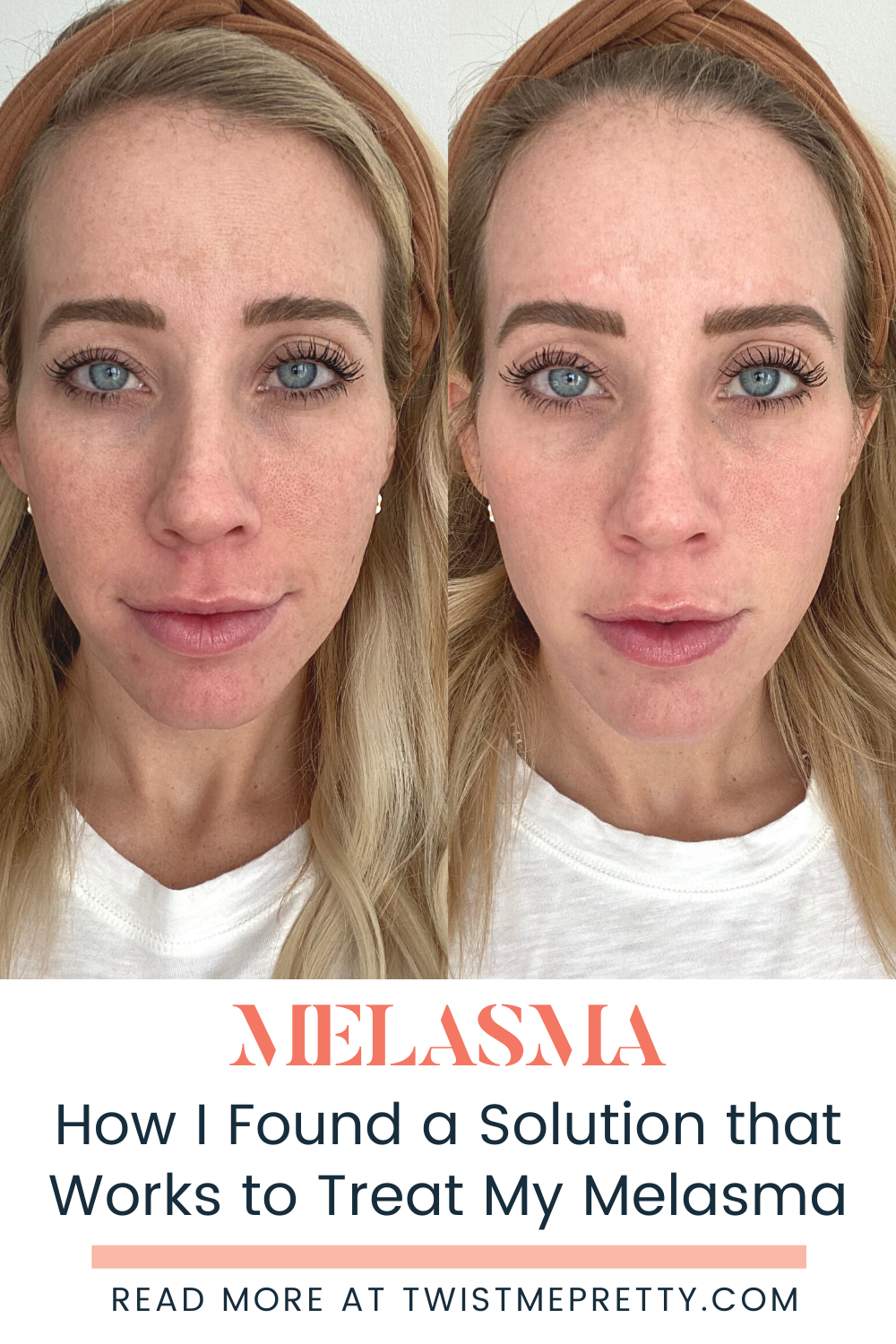 treating-melasma-with-the-light-and-bright-laser-twist-me-pretty